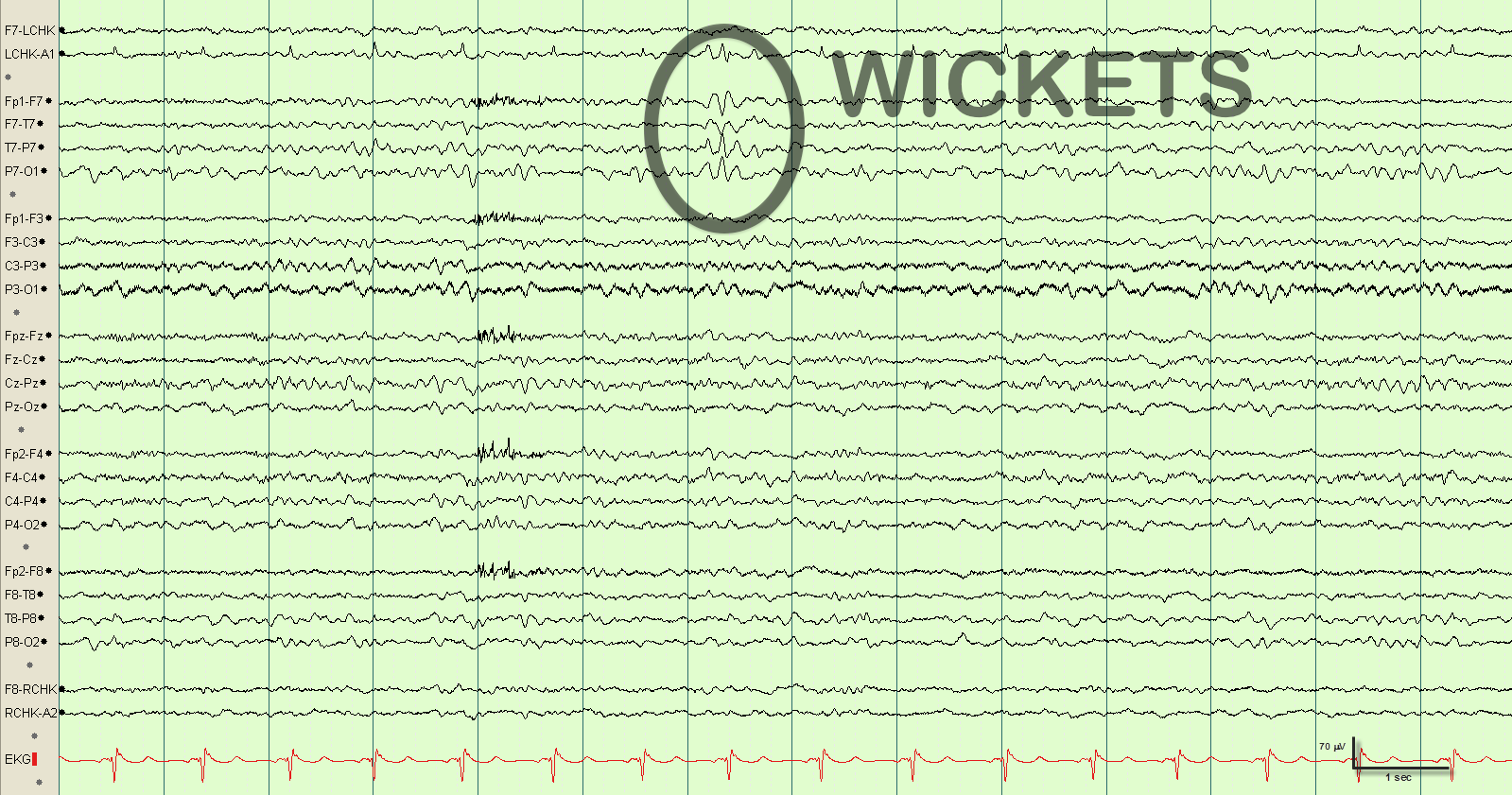 Потенциал ээг. Wicket спайки ЭЭГ. Wicket потенциалы на ЭЭГ. Wicket Waves EEG. Бета ритм ЭЭГ.