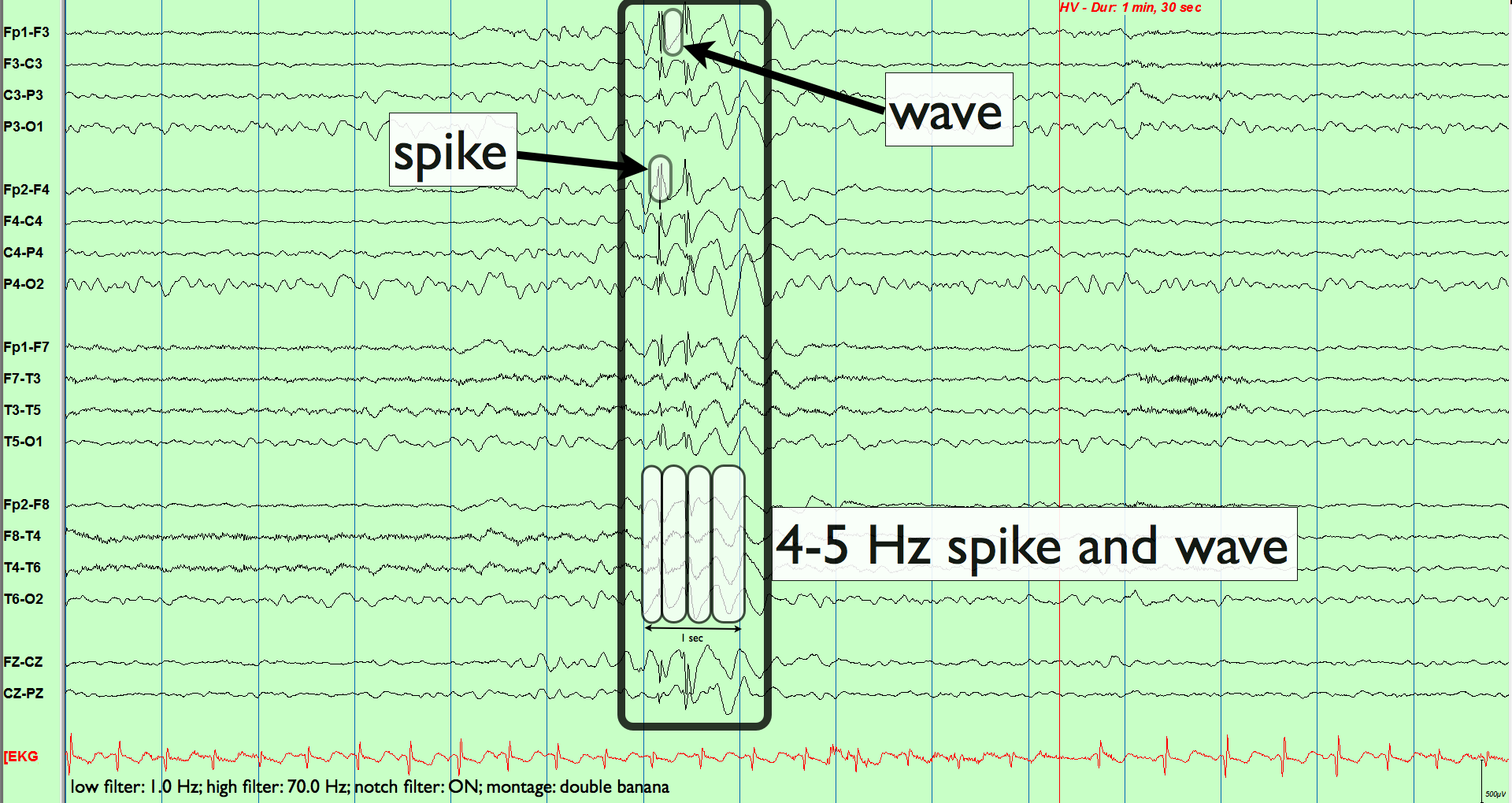 Спайк на ээг. Спайк волна при эпилепсии. Спайк волна на ЭЭГ. Спайк медленная волна на ЭЭГ что это.