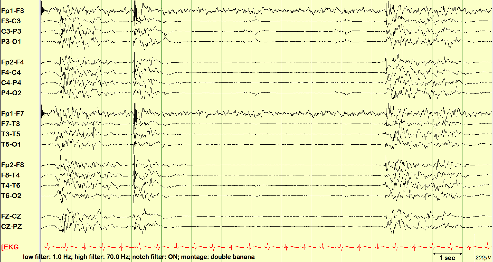 SPIKES  T3 Index